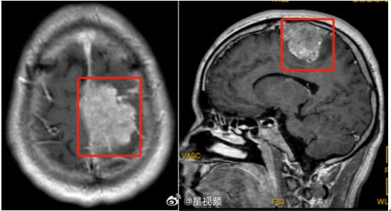 男子因夹不住人字拖被查出脑瘤：人往前走 鞋在原地